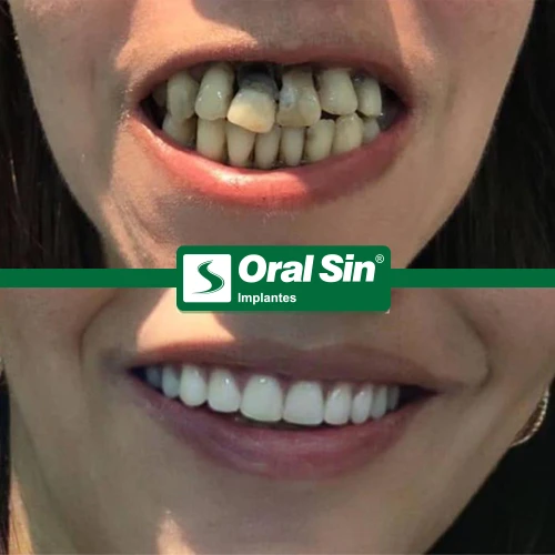 AntesEDepois_01_Oralsin - Copia