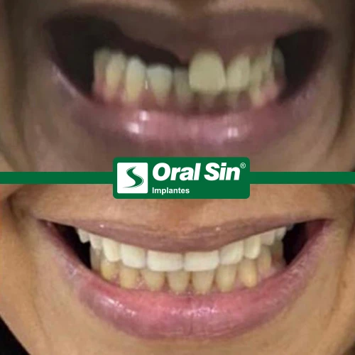 AntesEDepois_02_Oralsin - Copia