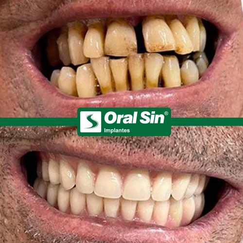 AntesEDepois_03_Oralsin